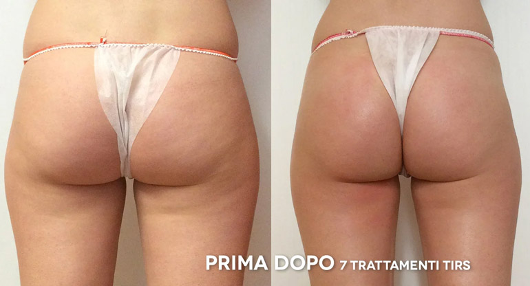 MyBeautyArt-Metodo-TIRS-risultati